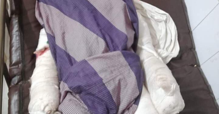 চকরিয়ায় অগ্নিদগ্ধ হয়ে দোকানীর মৃত্যু